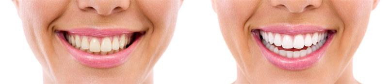 Tooth Whitening Before & After